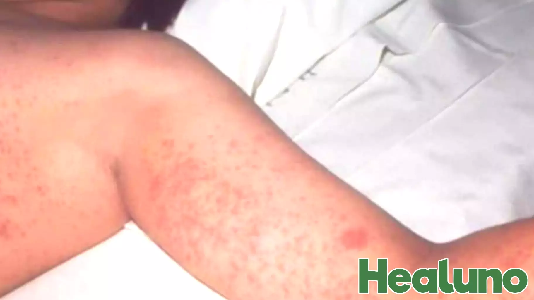 Texas Faces Severe Measles Outbreak with 48 Confirmed Cases