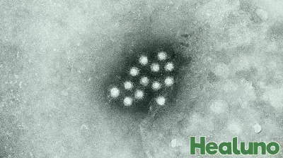 Health Officials Alert Community to Possible Hepatitis A Risk at Local Restaurant